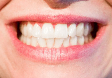 Bleaching - Zähne bleichen